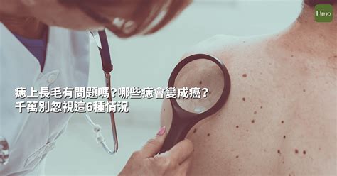 痣長白毛|痣上長毛有問題嗎？哪些痣會變成癌？千萬別忽視這6種情況